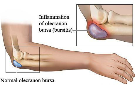 La bursitis es una inflamación de la bursa que al llenarse de líquido produce dolor intenso. 