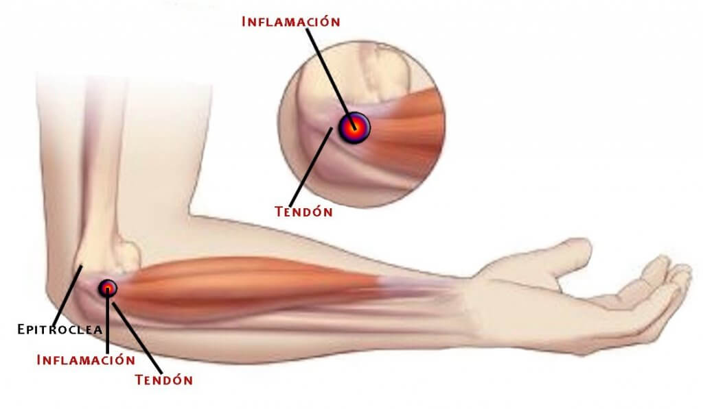 El codo de golfista se produce por una inflamación y extrema degeneración de la zona muscular tendinosa en la articulación del codo.
