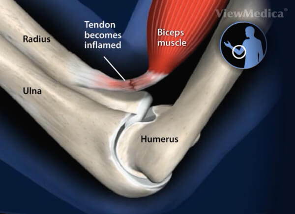 La tendinitis de bíceps es una lesión muy molesta y dolorosa.