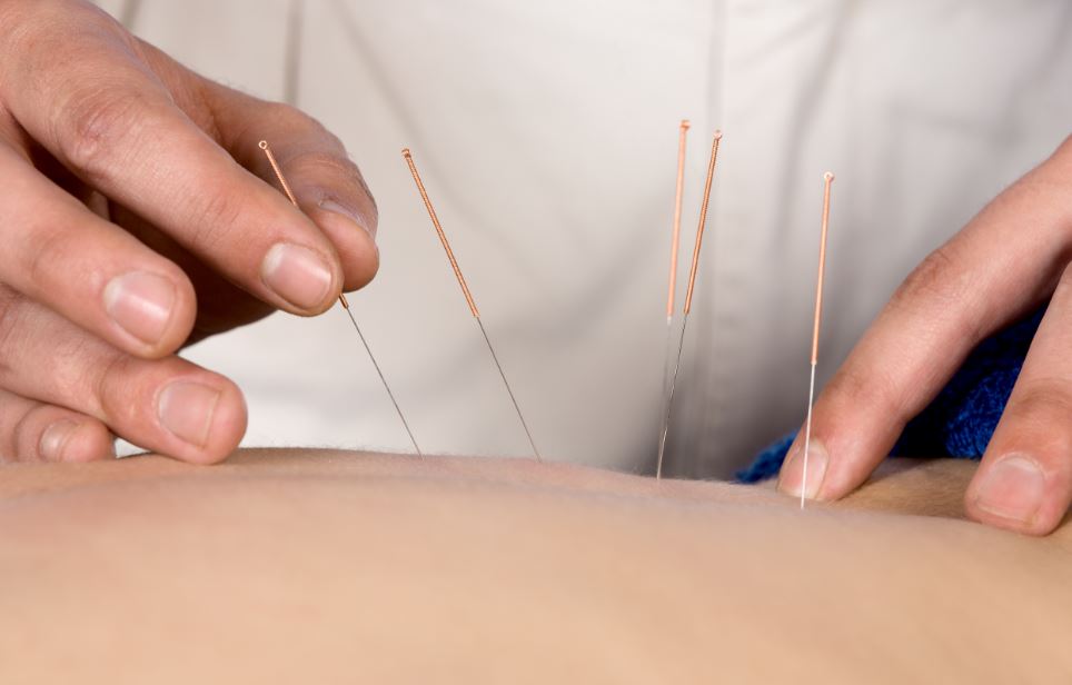 La acupuntura es una técnica de medicina alternativa.