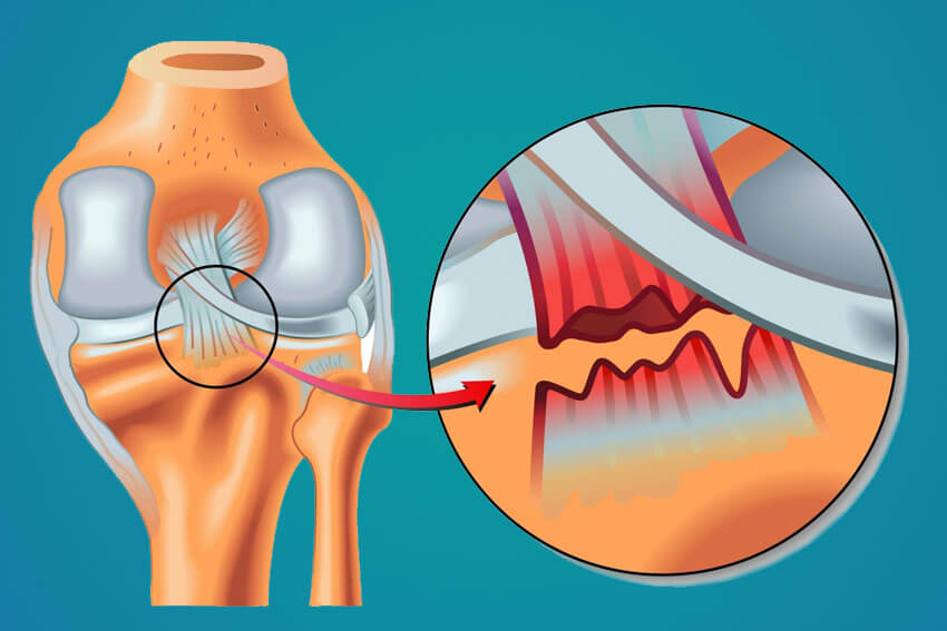 El ligamento cruzado posterior suele lesionarse a causa de traumatismos.