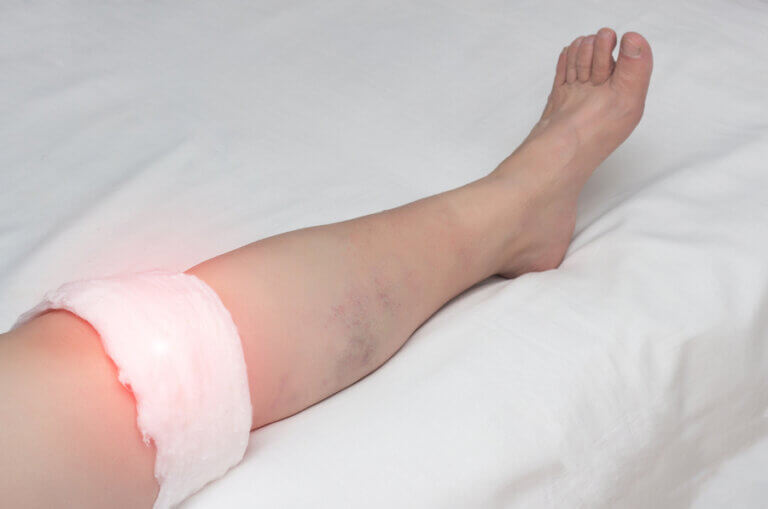 ¿Cuáles son los síntomas de la bursitis de rodilla?
