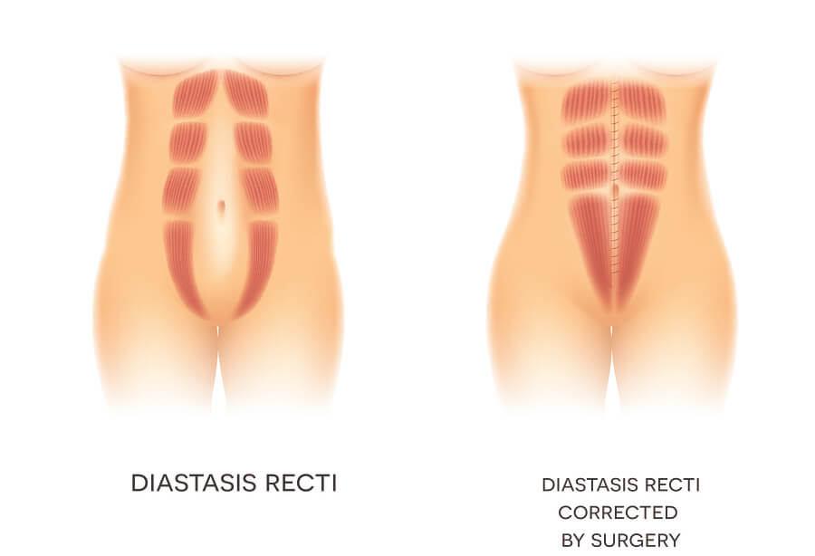 Caso grave de diástasis abdominal corregida por cirugía.