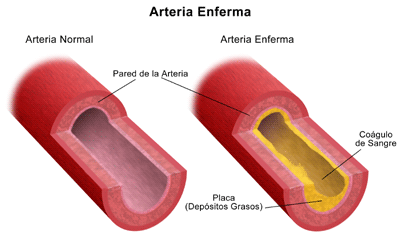 La arteriosclerosis es una de las enfermedades cardíacas más comunes.