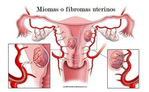 Diagrama de miomas o fibromas uterinos