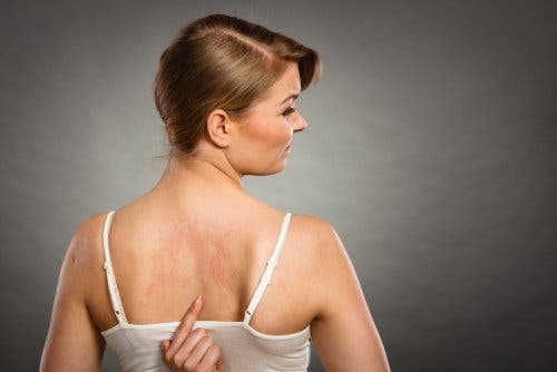 Mujer con alergia por aditivos alimentarios