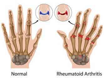 Artritis reumatoide, cómo controlar sus síntomas