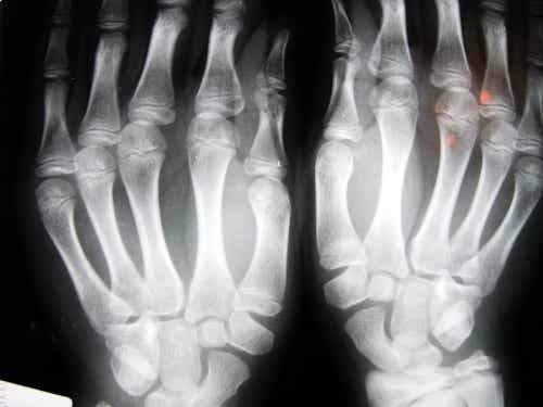 Según estudio, personas que tienen el dedo índice más corto que el resto, tienen mayor riesgo de presentar osteoartritis