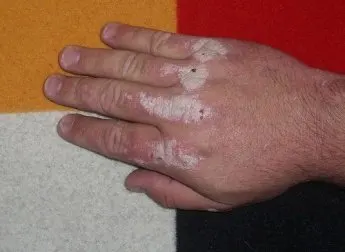 Tratamientos y consejos para la psoriasis