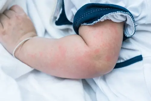 Sarpullidoo en un bebé