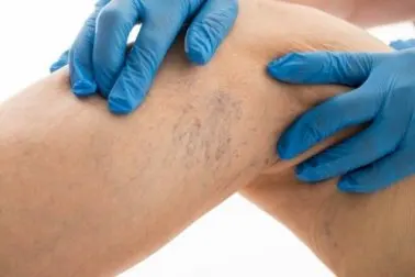 Claves para reducir las varices