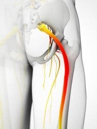 Cómo reducir el dolor del nervio ciático