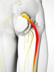 Cómo reducir el dolor del nervio ciático