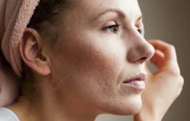Cómo tratar los poros dilatados