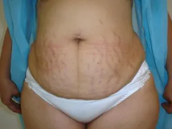 Alimentos y tratamientos naturales para las estrías