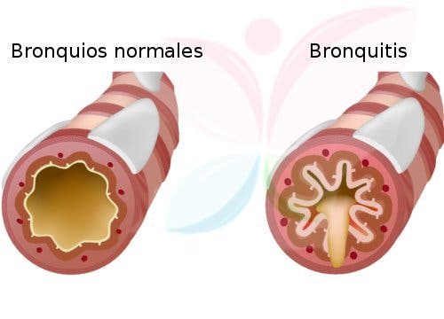 Bronquitis normales y malos
