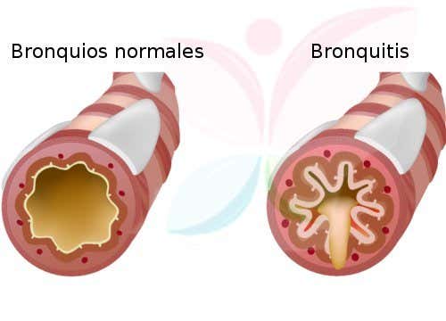 Bronquitis normales y malos