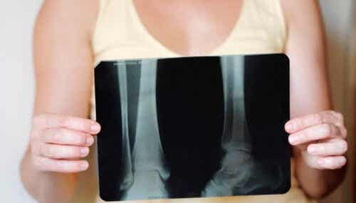Consejos para la osteoporosis