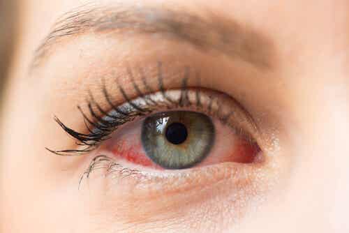 Los ojos rojos, las causas comunes y su tratamiento