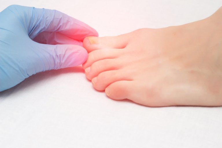 Consejos útiles para la onicomicosis