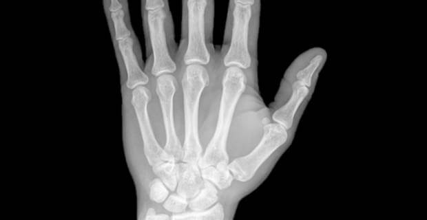 ¿Hay cura para la artritis reumatoide?