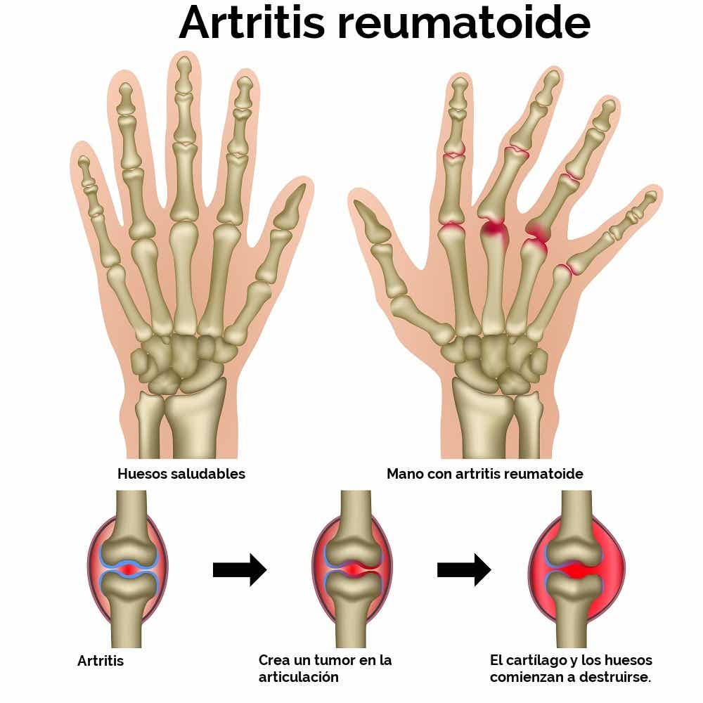 Artritis-reuma