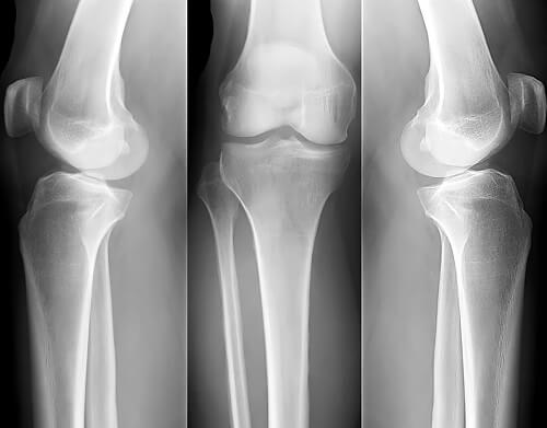 Remedios caseros para la osteoporosis