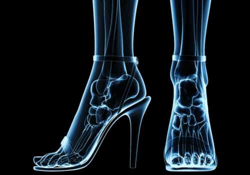 Consecuencias para la salud del uso excesivo de zapatos de tacón