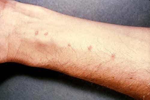 Tratamientos caseros para la dermatitis alérgica