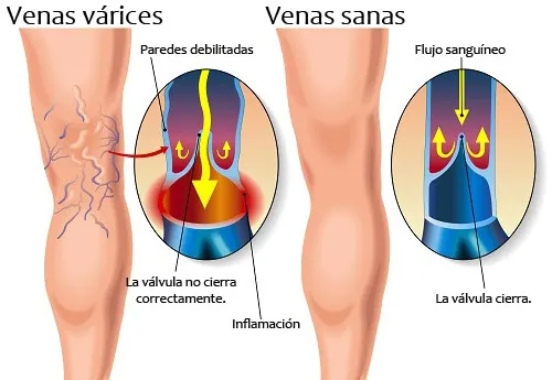 Piernas con várices