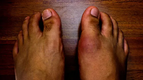 6 alimentos que causan gota