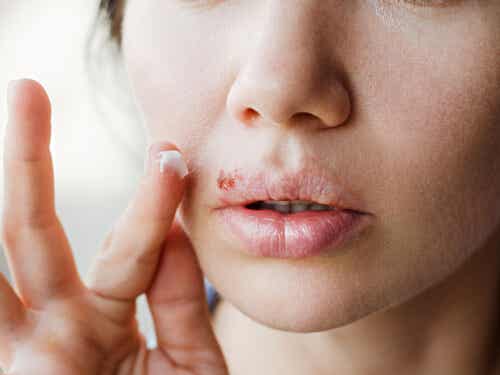 ¿Tratamientos naturales para el herpes labial?