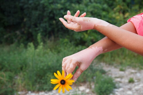 Manos con vitiligo con una flor