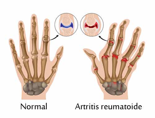 7 pasos para superar la artritis reumatoide
