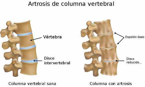 Artrosis columna