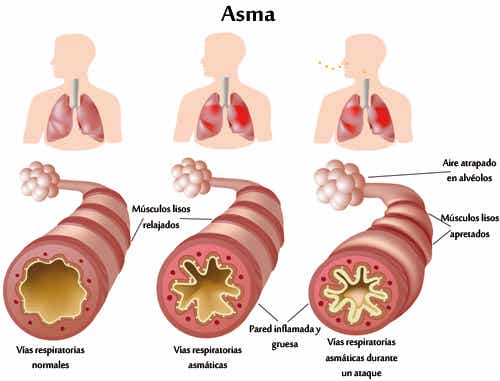 ¿Qué hacer si se sufre de asma crónico y alergias?