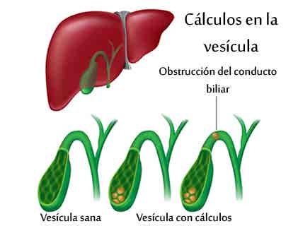 Anatomía de la vesícula y formación de cálculos biliares.