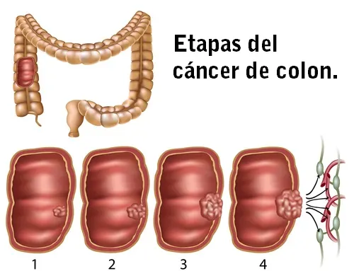 Cáncer de colon
