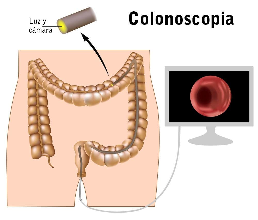 La colonoscopia para analizar el colon
