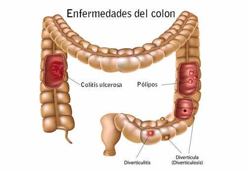 Enfermedades comunes del colon: ¿Cómo prevenirlas?