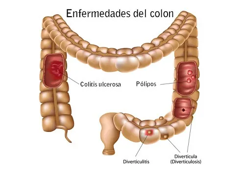 Enfermedades comunes del colon: ¿Cómo prevenirlas?