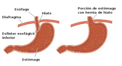 7 remedios naturales para la hernia de hiato