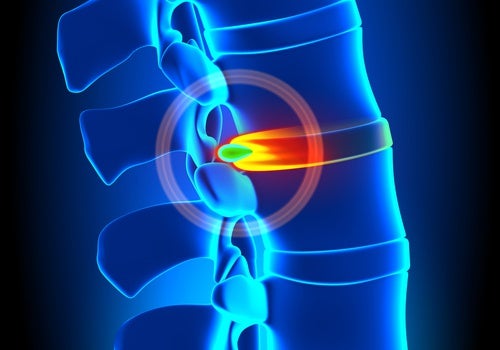 Hernia discal, ¿cómo tratarla y prevenirla?