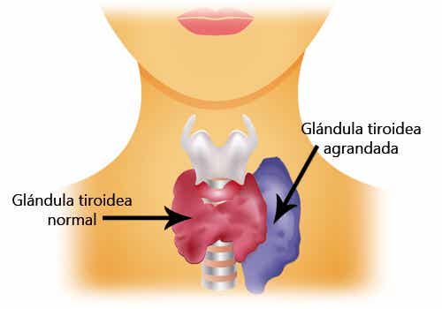 El hipertiroidismo se presenta cuando la tiroides está demasiado estimulada y produce más hormonas de las necesarias