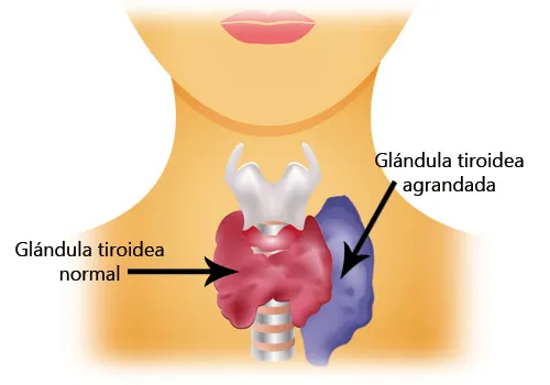 O hipertireoidismo ocorre quando a tireoide está superestimulada e produz mais hormônios do que o necessário