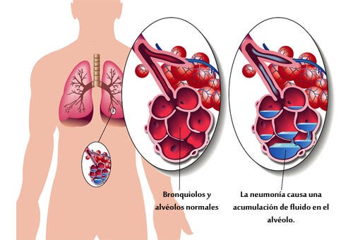 Alimentos para ayudar a tratar la neumonía