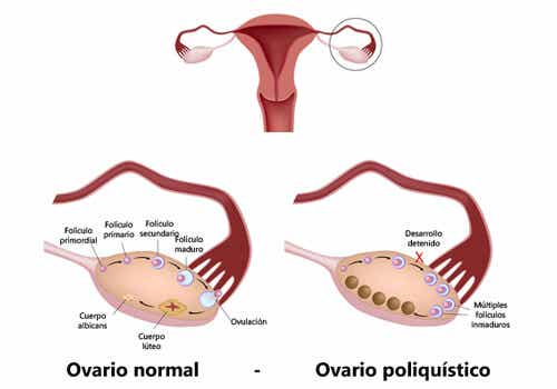 ¿Qué es el ovario poliquístico y cómo tratarlo?