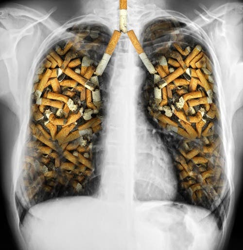 El hábito de fumar puede causar enfermedades pulmonares