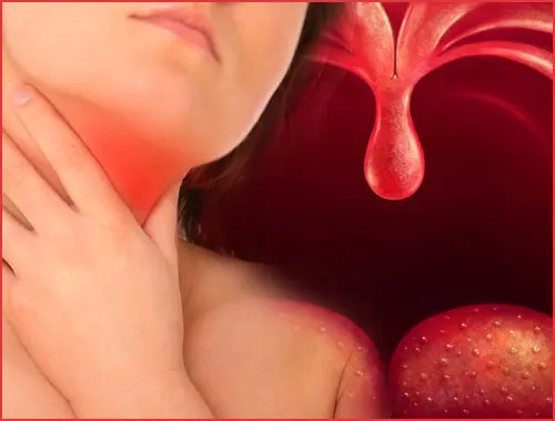Remedios naturales para la faringitis