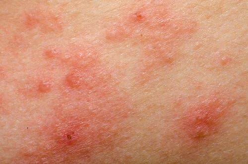 ¿Es recomendable utilizar remedios naturales para la rosácea?